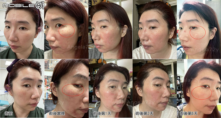 油臉敏感肌醫美小白第一次皮秒雷射! 斑掉下來!!