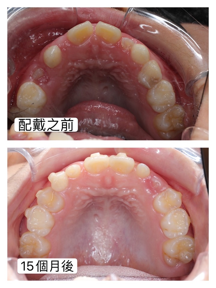 兒童隱適美配戴心得分享