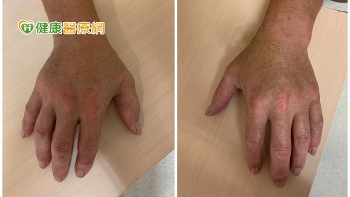 腳踝、手指腫痛竟是乾癬性關節炎靠生物製劑降發炎