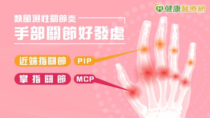 炒菜無法施力竟是類風濕性關節炎作怪！