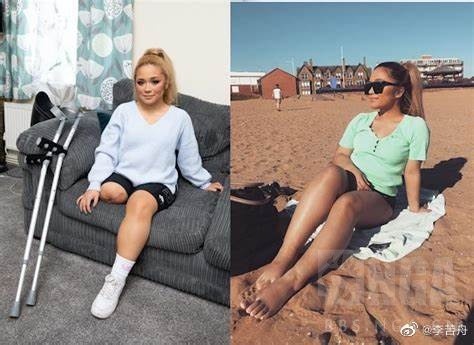 似乎很少报道：新冠血栓不得不截肢