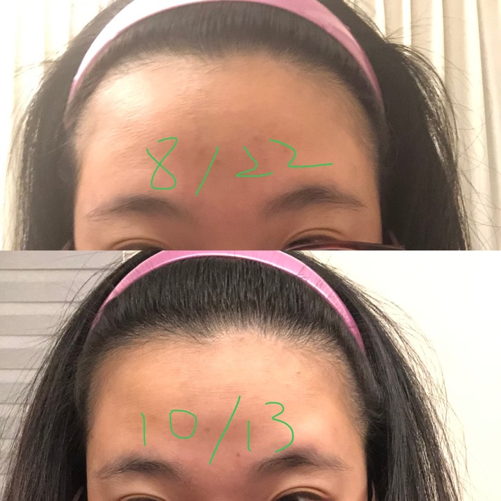 IRestore pro 雷射生髮帽 2個月使用心得