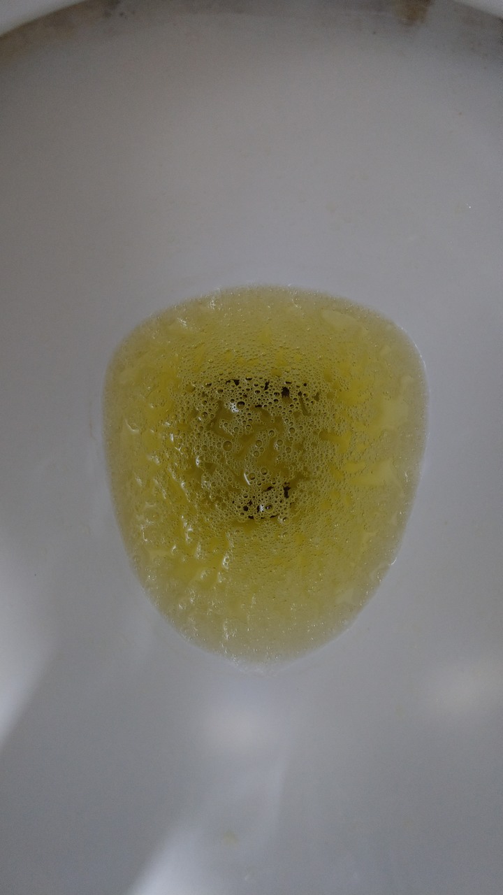 得了新冠肺炎出現泡泡尿(內有噁圖慎入)