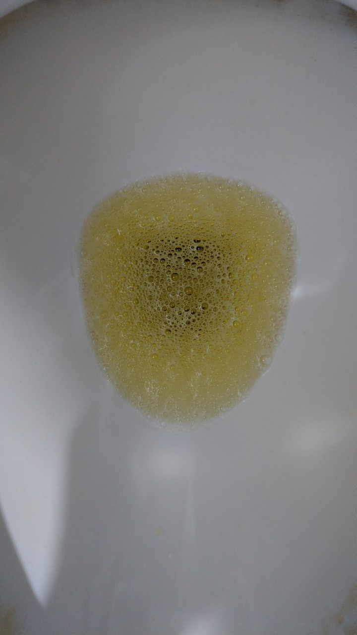 得了新冠肺炎出現泡泡尿(內有噁圖慎入)