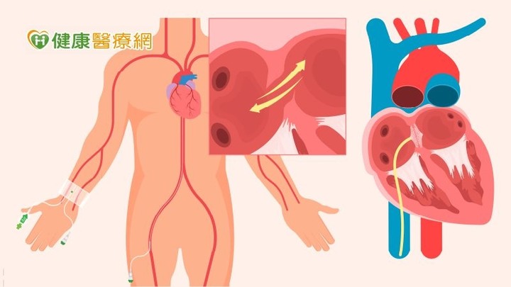 點我看大圖 三成中風患者恐二度中風!不明原因中風需警覺恐為卵圓孔未閉合