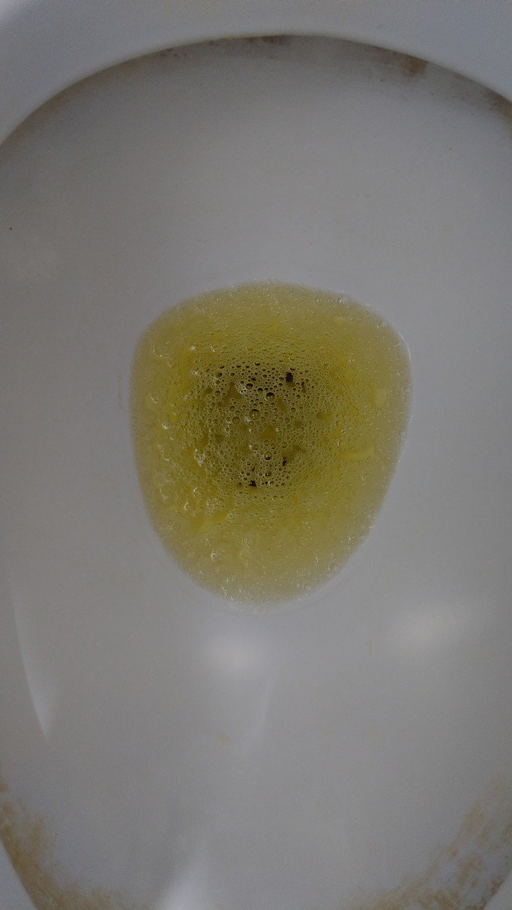 得了新冠肺炎出現泡泡尿(內有噁圖慎入)