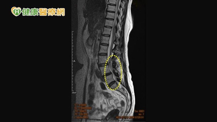 點我看大圖 「脊椎狹窄」腰痛腿麻、走不動靠這招改善症狀助減壓