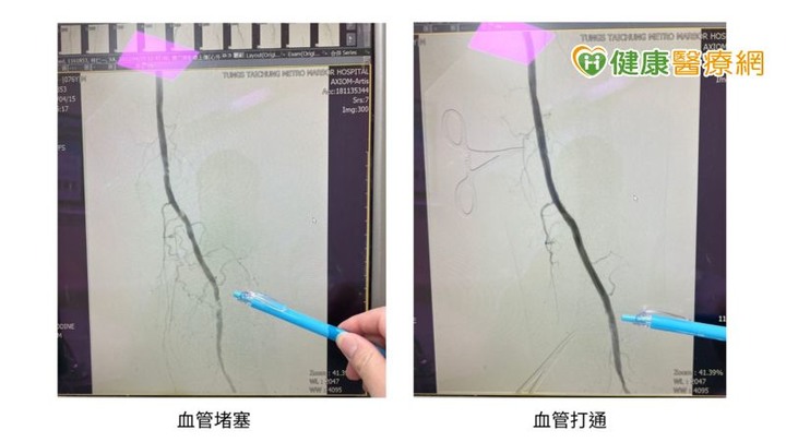 小腿冰冷發麻、走一下下就累醫提醒：下肢血管已嚴重老化
