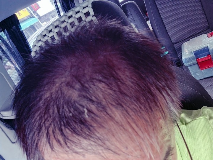 Alpecin Scalp care 油性頭皮專用洗髮露，神奇的讓油膩及頭髮髒亂消失 二個月心得
