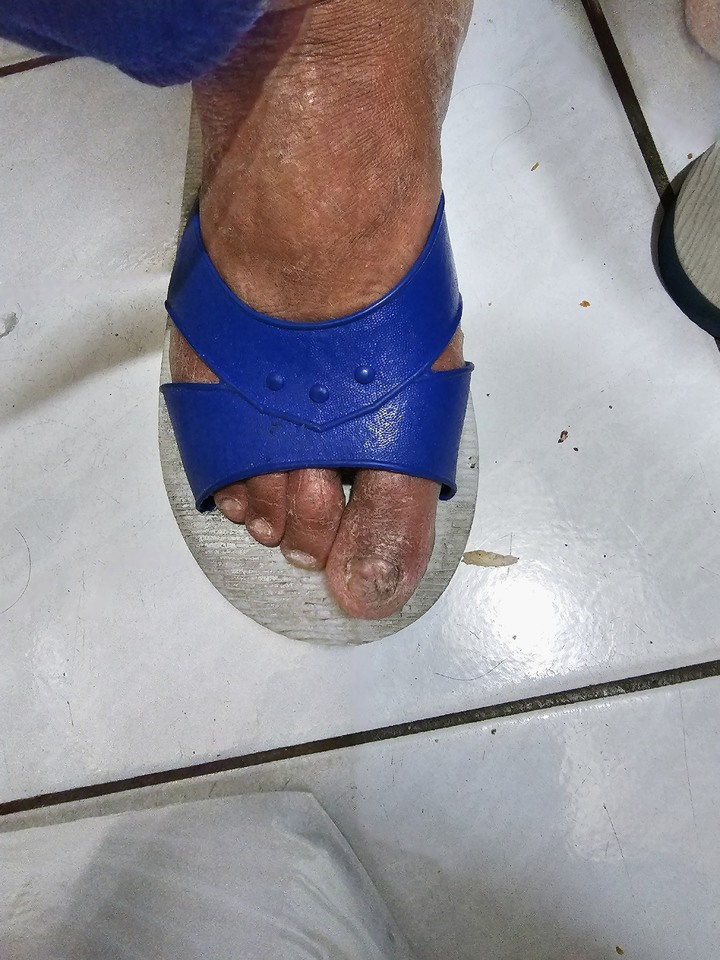 請問這是糖尿病的腳初期症狀嗎？