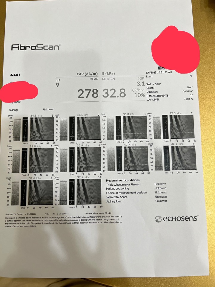 肝硬化還是上門來了