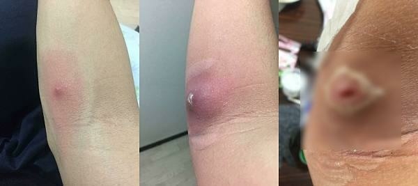 【健保給付補貼教學】出國看醫生怕貴?可回台申請健保核退!