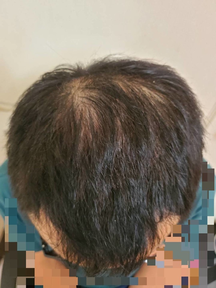 壓力大的落髮該怎辦?