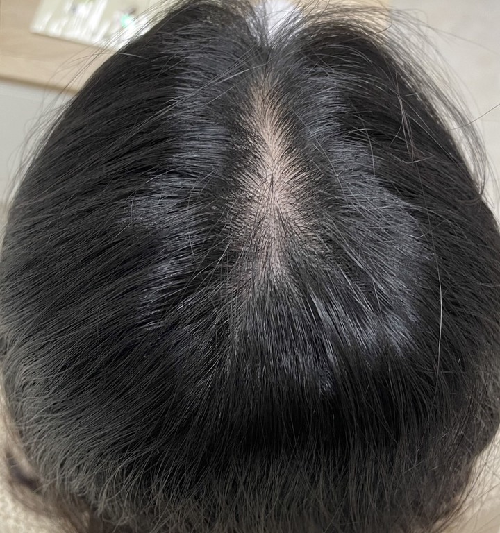 產後中醫落髮治療改善分享