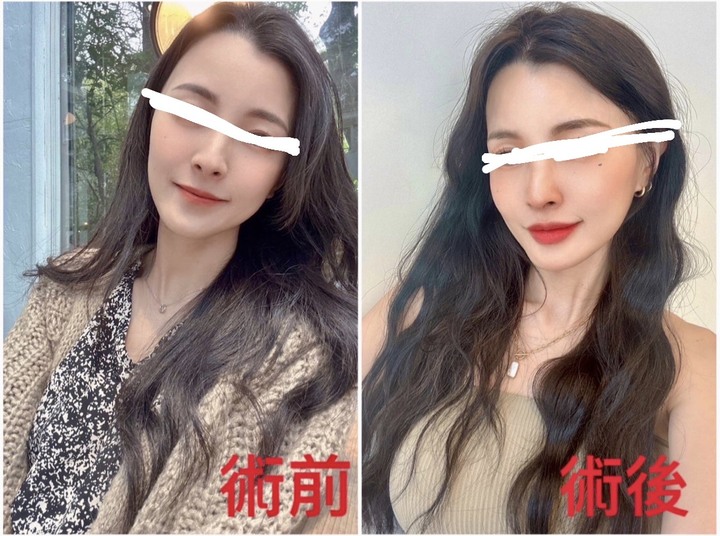 畫嘴唇變得超好畫,緹奧希玻尿酸豐唇挺自然～