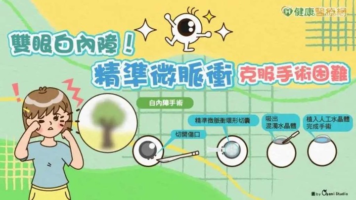 30多歲竟雙眼白內障！宜蘭陽大附醫引進「精準微脈衝」嘉惠宜蘭鄉親