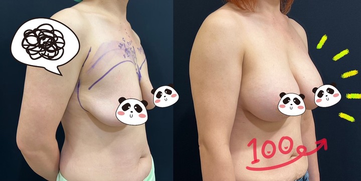 點我看大圖 【有圖慎入】終於下定決心隆乳~魔滴手術心得分享