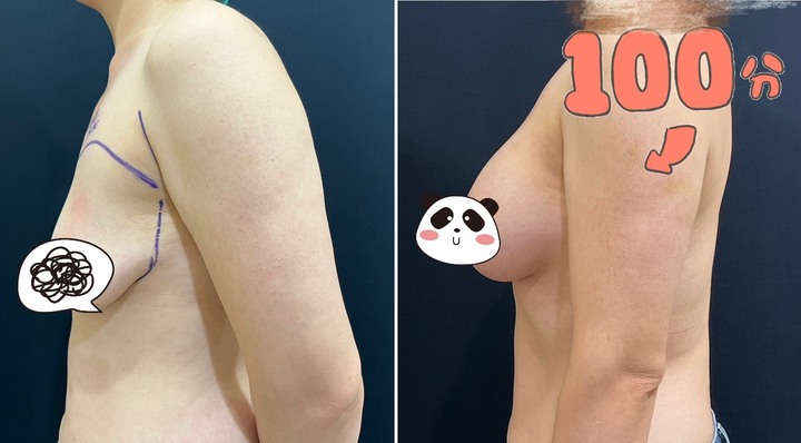 點我看大圖 【有圖慎入】終於下定決心隆乳~魔滴手術心得分享