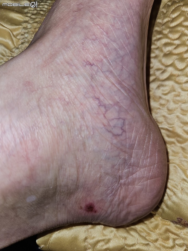 點我看大圖 左腳內側腳踝兩處痛,找哪一科比較適合?