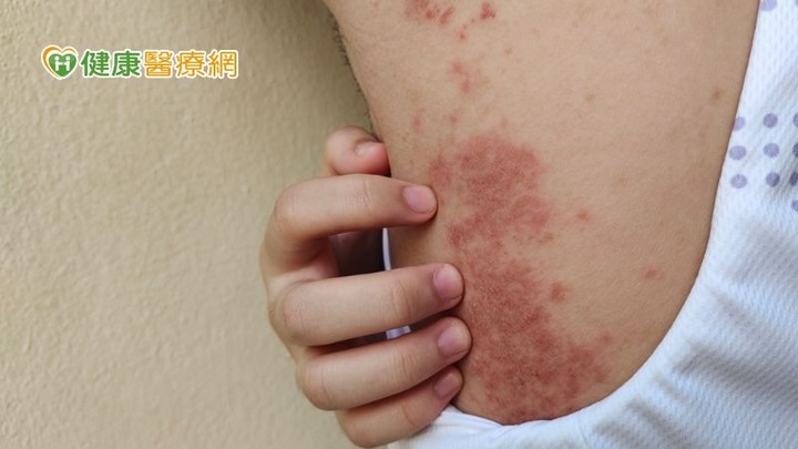 點我看大圖 合併乾癬與化膿性汗腺炎!40歲上班族靠「生物製劑」重生