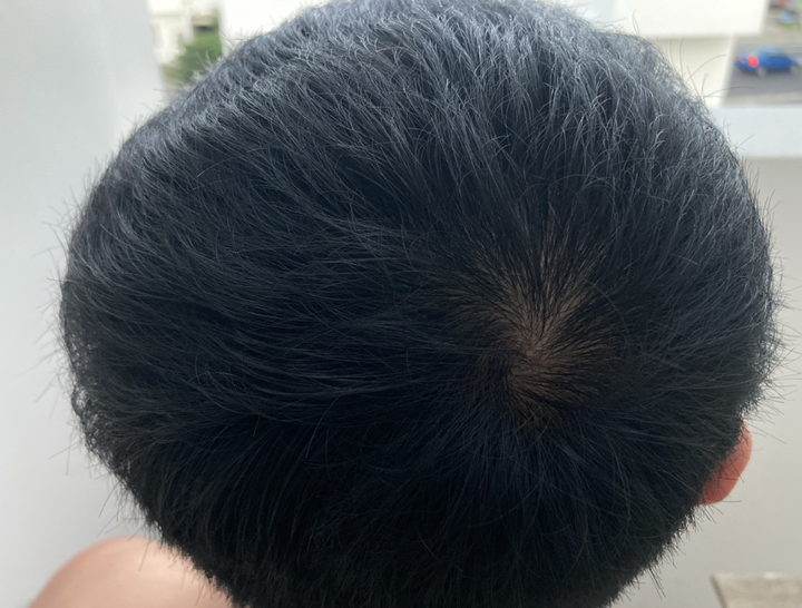 壓力落髮Part.2 升級生髮帽後近況分享