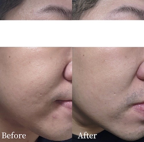 油肌大推～碧兒泉煥膚水 粉刺痘痘退散！