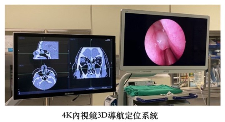 慢性鼻竇炎治療新科技膠原蛋白基質粉輔助傷口癒合