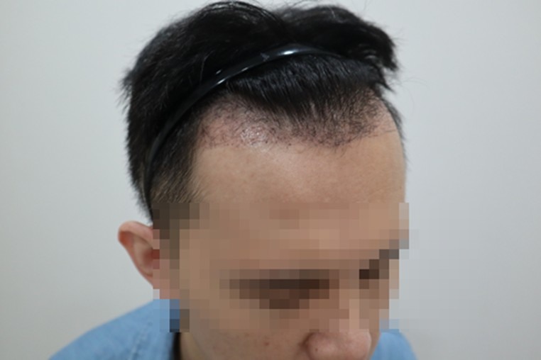 高雄植髮心得 植髮心路歷程分享