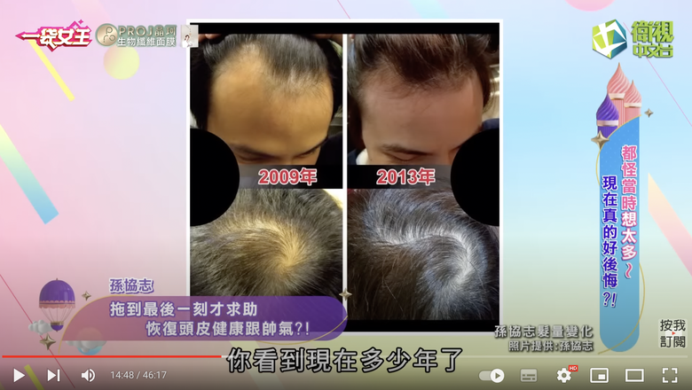 孫協志的髮量變化