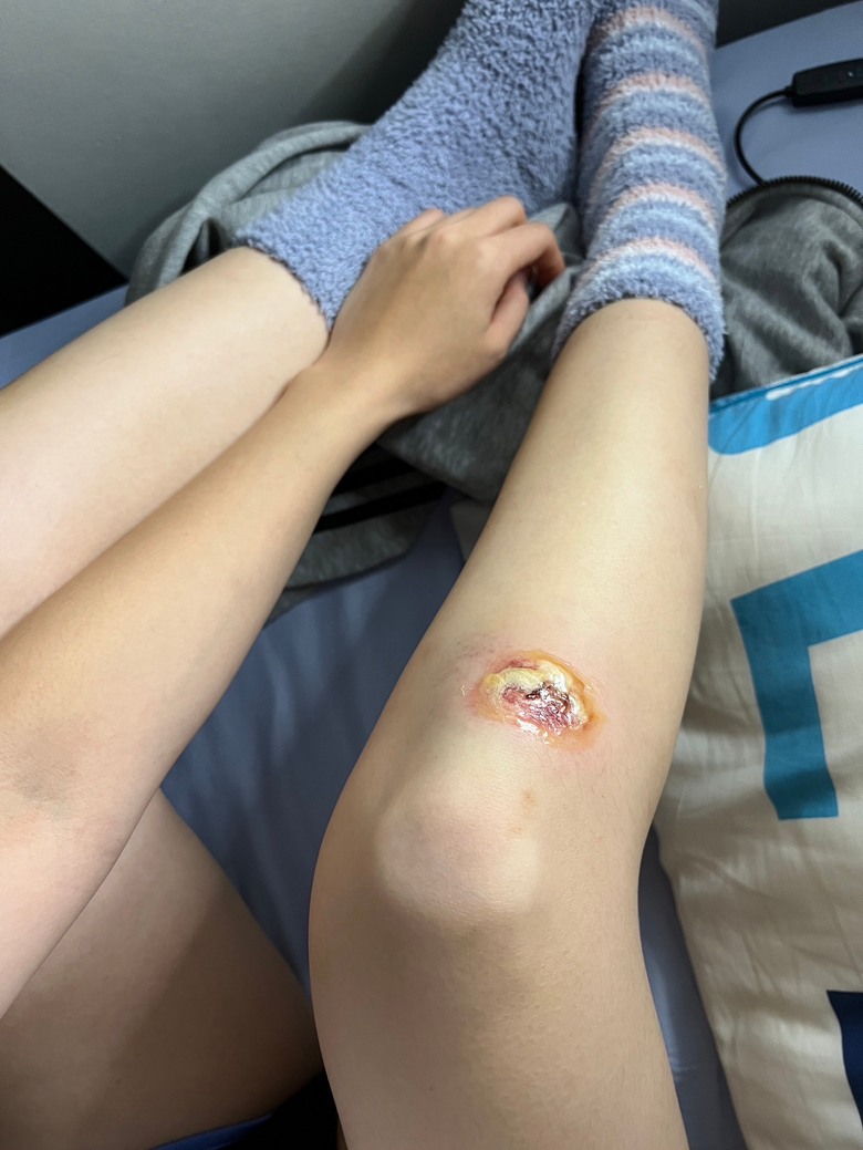 跌倒意外找到的好用除疤品