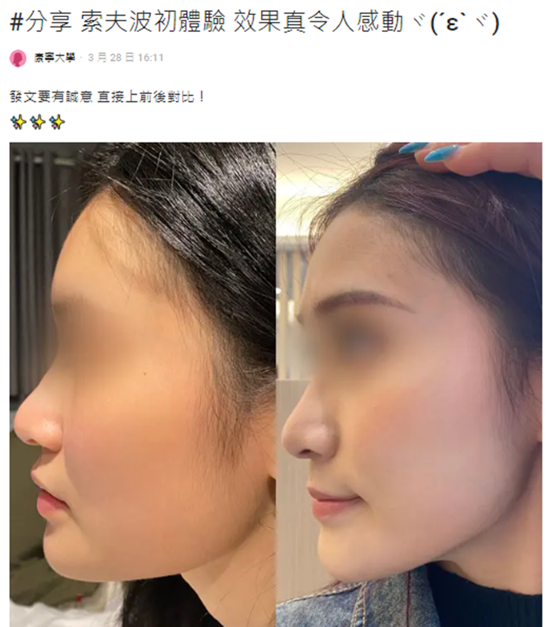索夫波全臉只要打300發就夠了嗎?