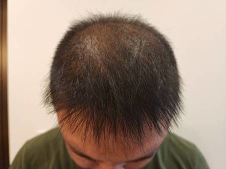 #生髮分享 不要放棄生髮,頭頂及後腦杓禿的地方真的都長出頭毛了!