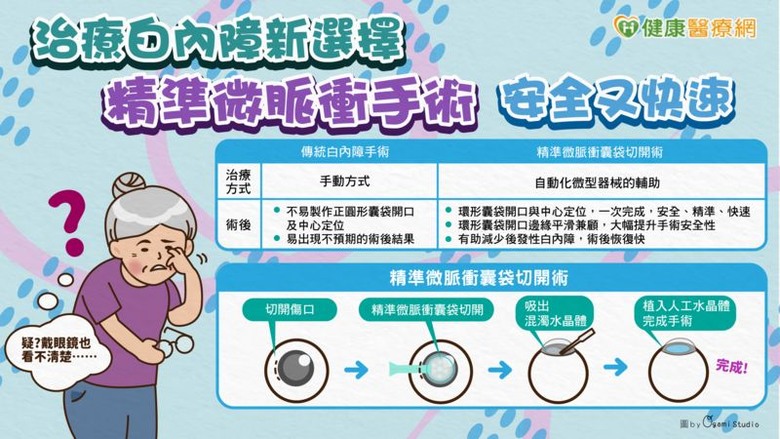 治療白內障新選擇精準微脈衝手術安全又快速
