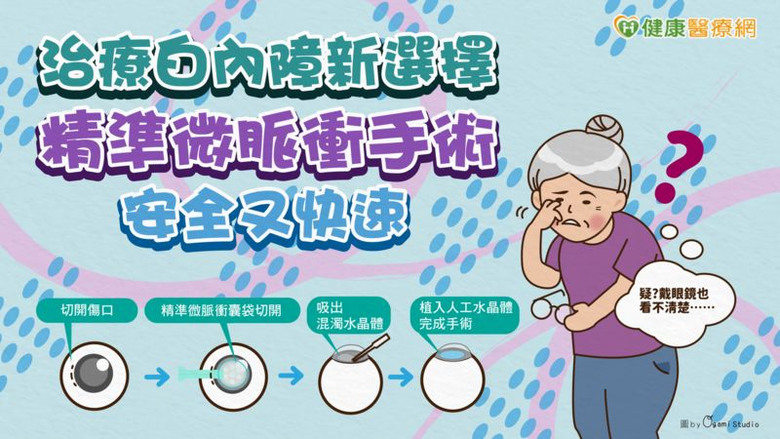 治療白內障新選擇精準微脈衝手術安全又快速