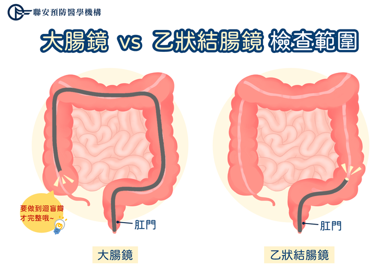 九成大腸癌是由息肉演變!哪種息肉癌變機率最高?