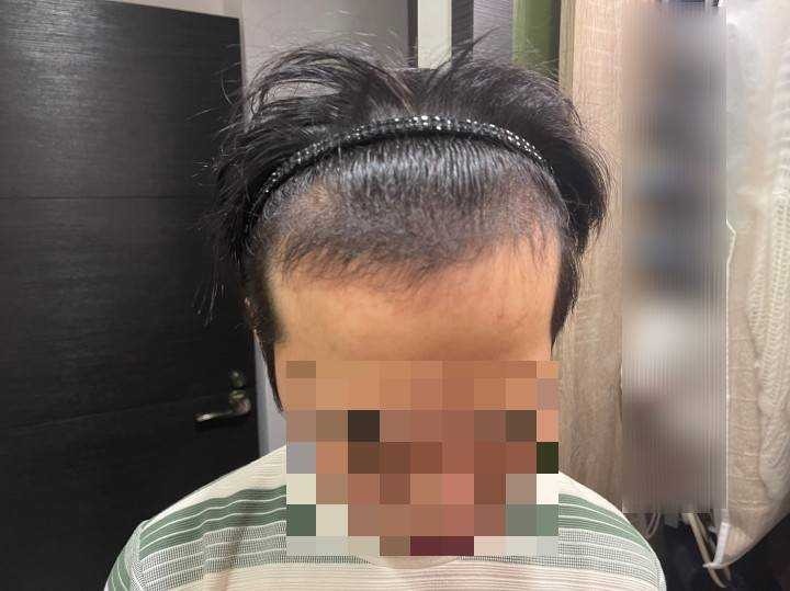 萌髮FUE植髮心得分享(術後一年)