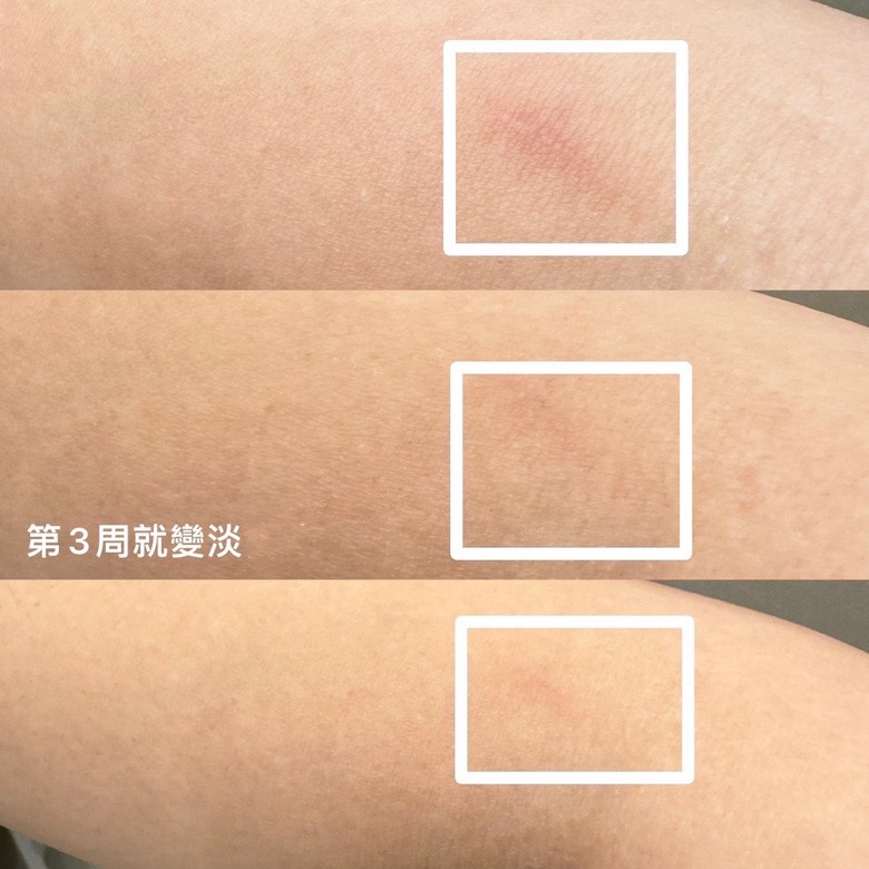 穀胱甘肽的淡疤效果真的有用欸