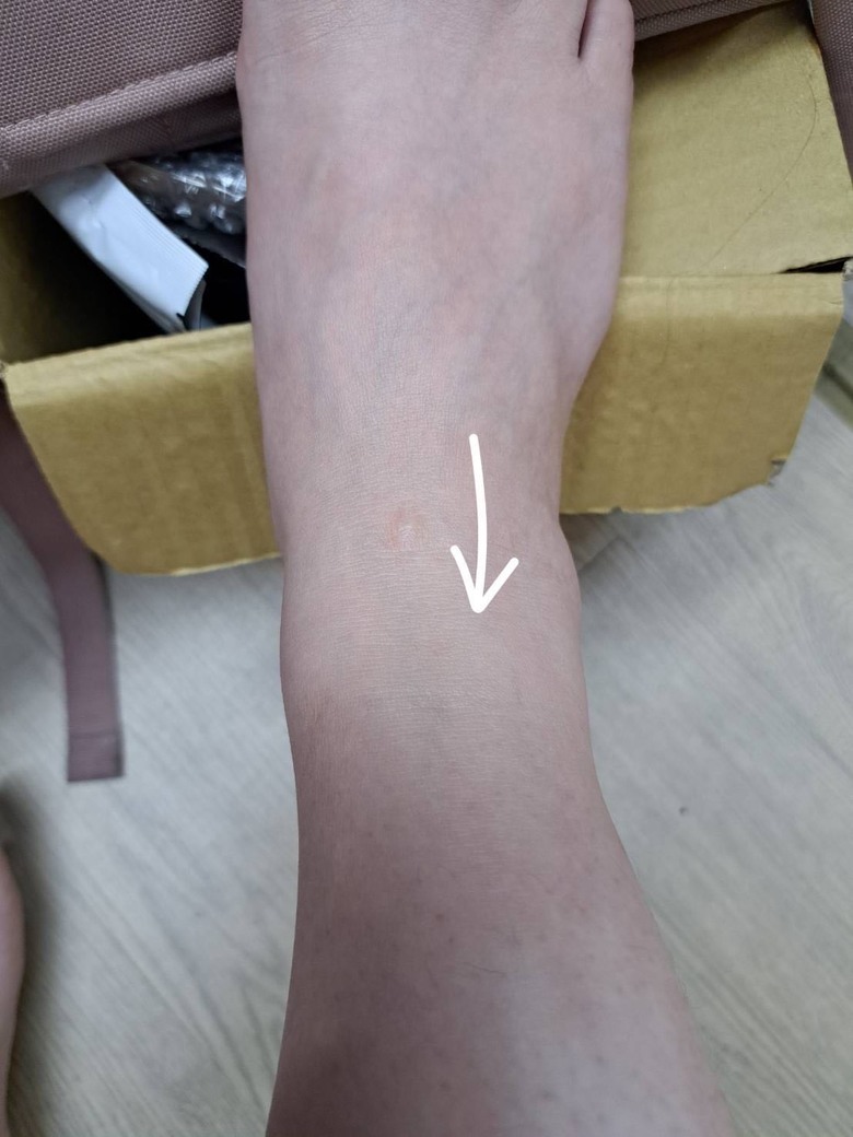 車禍傷口照護討論(預防留疤)