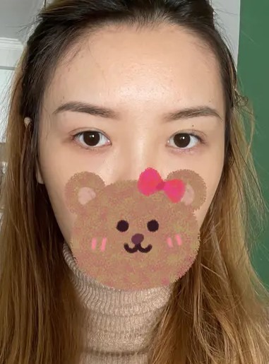#分享 東區醫美 消滅淚溝黑眼圈！