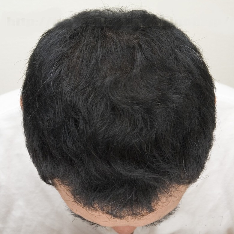 如何看待生髮的停滯期