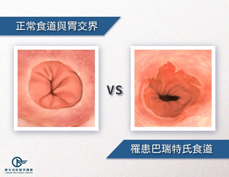 反覆胃食道逆流？小心巴瑞特氏食道找上身