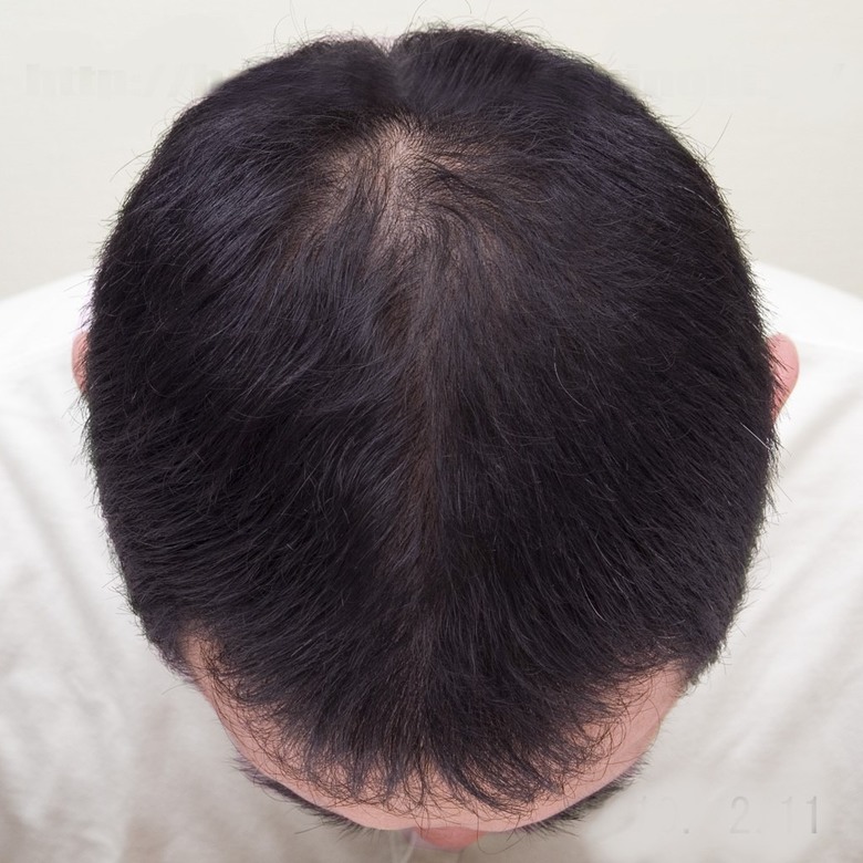 如何看待生髮的停滯期