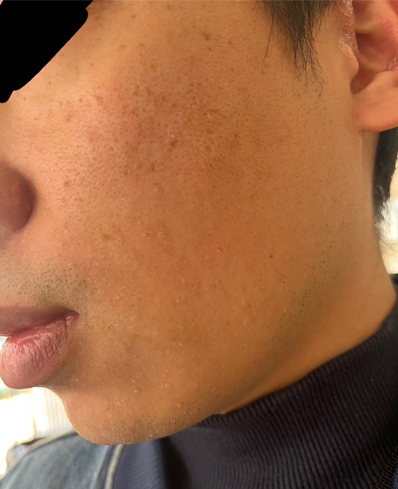 異位性皮膚炎改吃口服神經醯胺心得