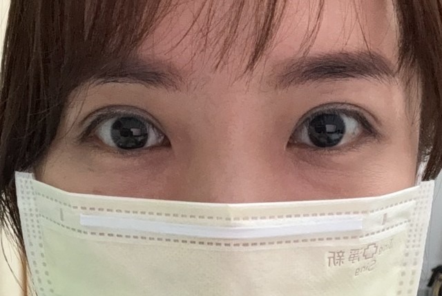 苦命眼窩凹陷變身 醫美才是最好的保養