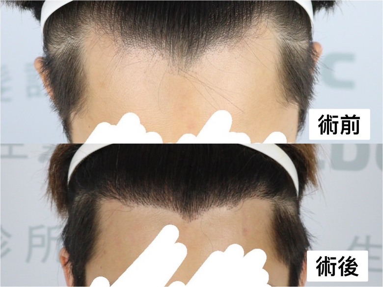 真心推可以去植髮