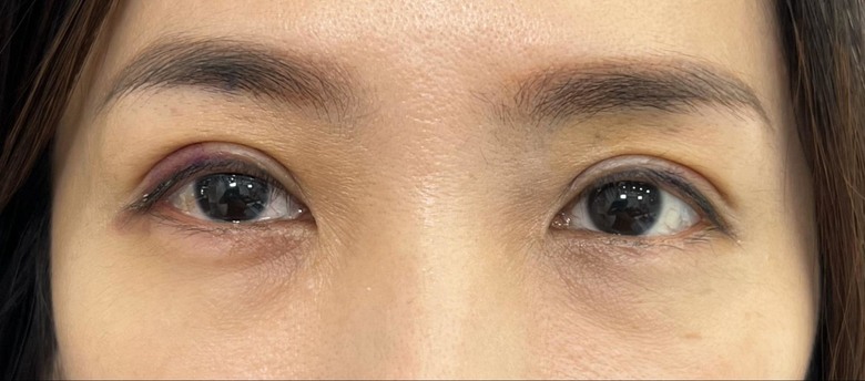苦命眼窩凹陷變身 醫美才是最好的保養