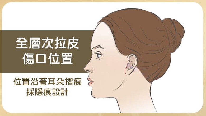 點我看大圖 多次拉皮效果不如預期?醫曝是「這原因」!解析全層次結構式拉皮特色及考量