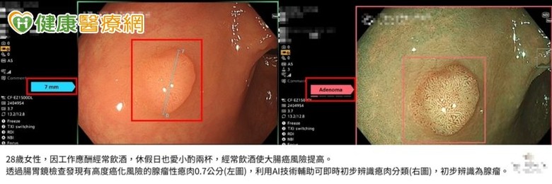 大腸癌年輕化警訊！28歲女業務應酬拚酒健檢意外發現癌化高風險瘜肉