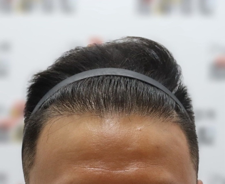 M角禿植髮過程與成果分享