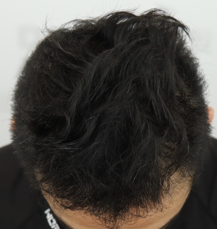 慶幸自己有去植髮,成果很滿意